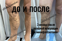 Результат минифлебэктомии и лазерной коагуляции вен