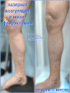 Лазер и минифлебэктомия