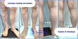 Лазерная коагуляция вен