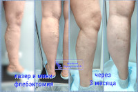 ЭВЛК и минифлебэктомия