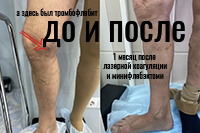 Результат минифлебэктомии и лазерной коагуляции вен