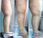 тотальная лазерная коагуляция магистральных вен и притоков