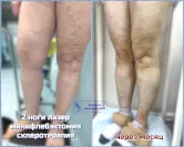 лазер, минифлебэктомия, склеротерапия