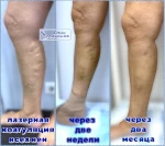 тотальный лазер вен