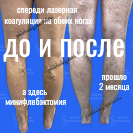 Результат минифлебэктомии и лазерной коагуляции вен