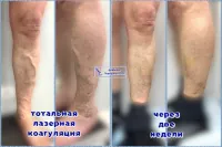 тотальный лазер вен