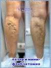 пигментация после минифлебэктомии