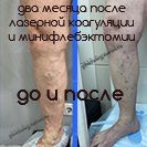 Результат минифлебэктомии и лазерной коагуляции вен