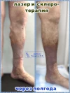 лазер и склеротерапия