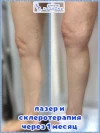 лазерная коагуляция и склеротерапия