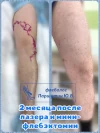 лазер и минифлебэктомия