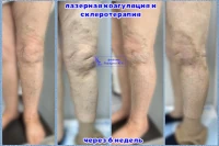 лазер и склеротерапия