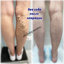 Лазер и минифлебэктомия