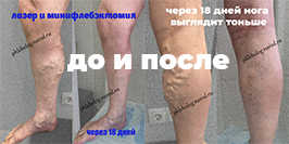 Результат минифлебэктомии и лазерной коагуляции вен на правой ноге