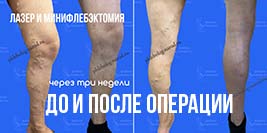 Результат минифлебэктомии и лазерной коагуляции вен на левой ноге