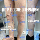 Результат минифлебэктомии и лазерной коагуляции вен на правой ноге
