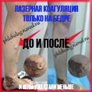 Результат лазерной коагуляции вен на правой ноге