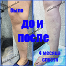 Лазер и минифлебэктомия