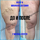 Лазер и минифлебэктомия