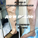 Лазер и минифлебэктомия