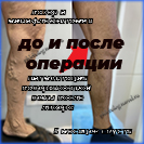 Лазер и минифлебэктомия