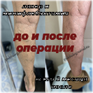 Лазер и минифлебэктомия