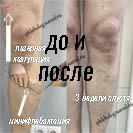 Лазер и минифлебэктомия