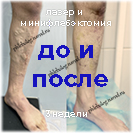 Лазер и минифлебэктомия