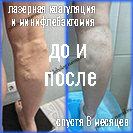 Лазер и минифлебэктомия