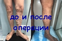 Трехнедельный результат после современной операции на венах