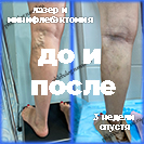 Лазер и минифлебэктомия