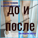 Лазер и минифлебэктомия