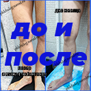 Лазер и минифлебэктомия