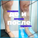 Лазер и минифлебэктомия