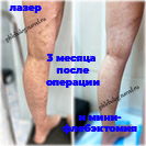 Лазер и минифлебэктомия