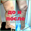 Лазер и минифлебэктомия