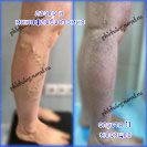 Лазер и минифлебэктомия