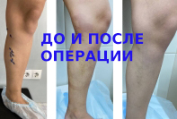 Результат лазерной коагуляции вен и минифлебэктомии