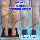 Лазер и минифлебэктомия на двух ногах