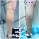 Лазер и минифлебэктомия, результат