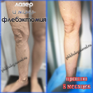 Лазер и минифлебэктомия, результат.