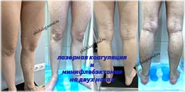 Лазер и минифлебэктомия, две ноги, результат