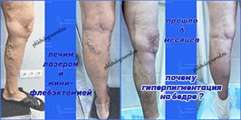 Лазер и минифлебэктомия, пигментация в области эпифасциального притока
