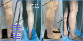 Лазер и минифлебэктомия