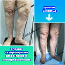 Лазер, склеротерапия и минифлебэктомия