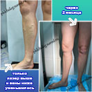 Лазерная коагуляция вен