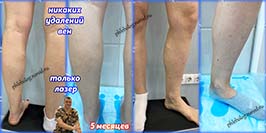 Лазерная коагуляция вен