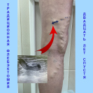 Рецидив варикоза после флебэктомии