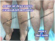 Лазерная коагуляция вен и минифлебэктомия