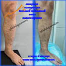 Лазерная коагуляция вен